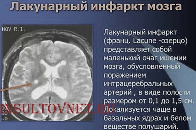 Признаки лакунарного инсульта