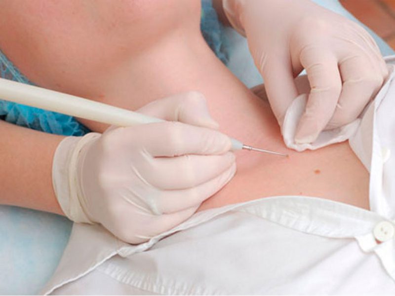 методика удаления папиллом