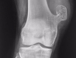 Рентген Остеохондрома