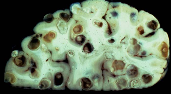 Цистицеркоз