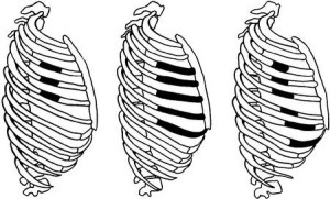 Изолированные переломы ребр Локализация переломов ребер