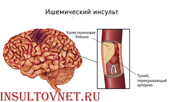 ишемический инсульт