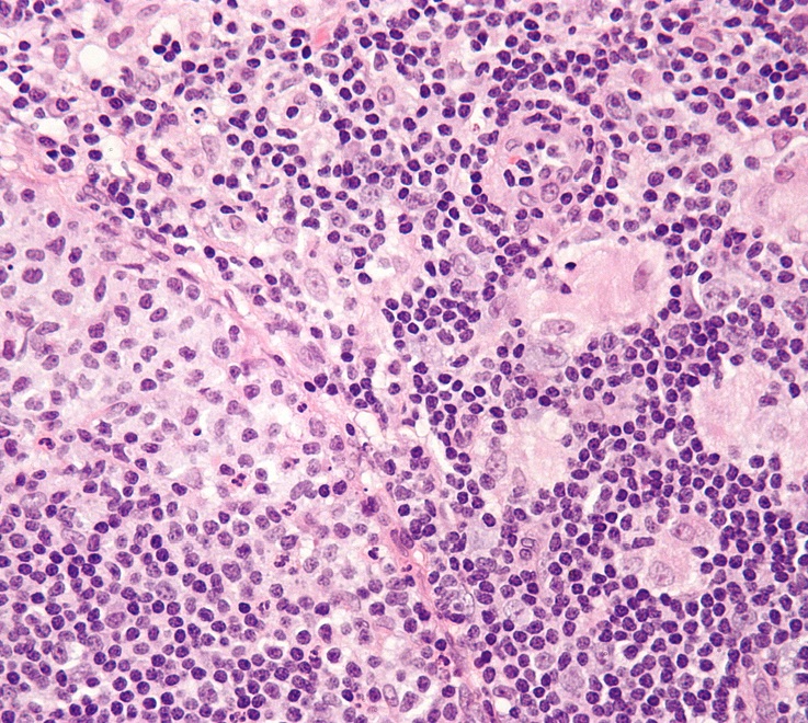 Токсоплазмоз