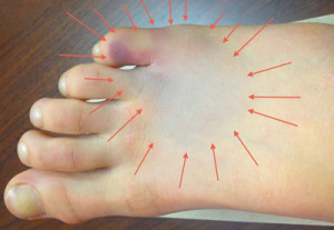 кости плюсны При переломе стопы, чаще всего повреждаются плюсневые кости