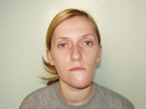 Вывих нижней челюсти у девушки Вывих челюсти