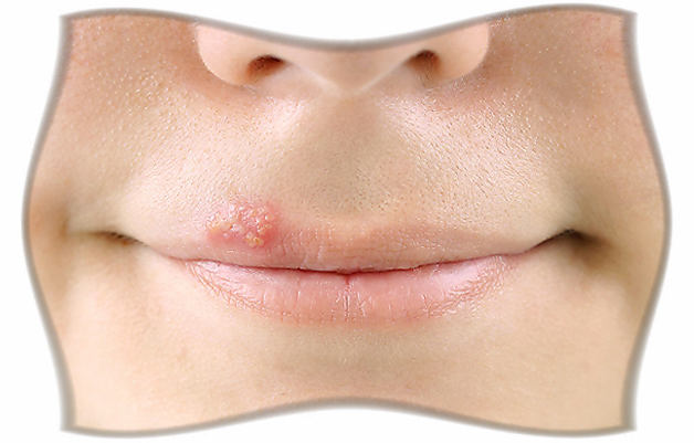 лечение герпеса