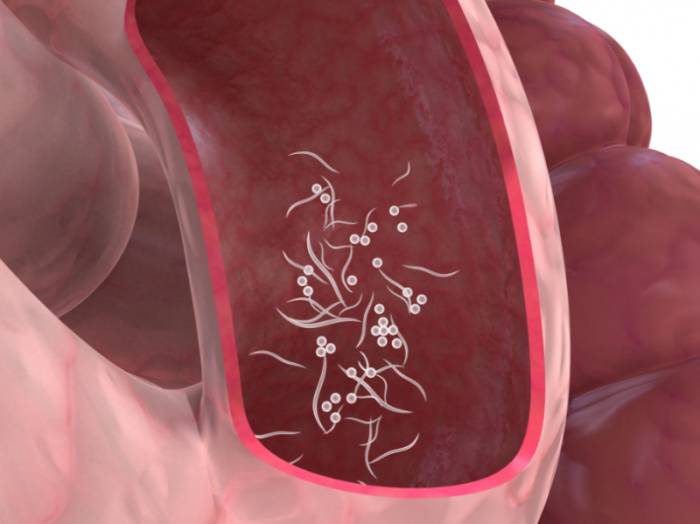 Лямблии в кишечнике