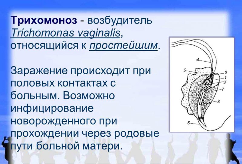 трихомоноз