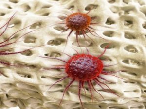 Клетки рака костей под микроскопом Метастазы саркомы костей