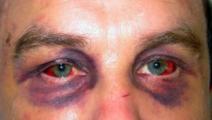 Наличие вдавленного перелома Симптомы травми черепа