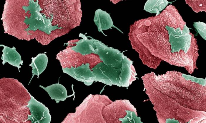 Трихомониаз