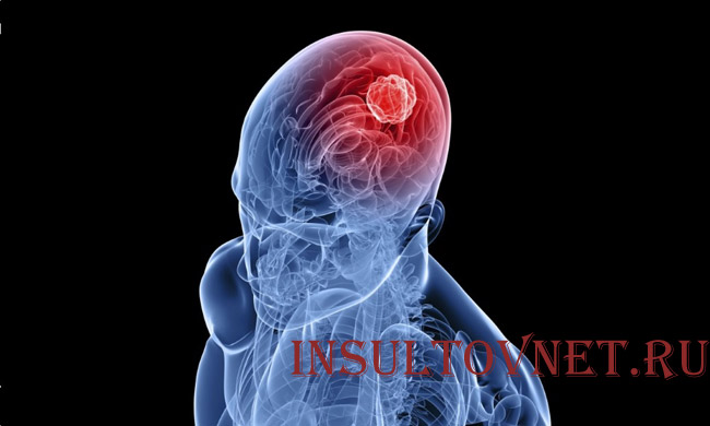 инсульт мозжечка