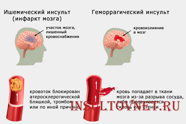 Легкая и тяжелая форма инсульта