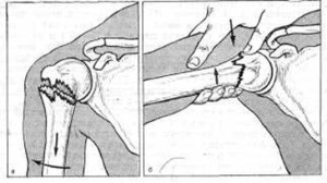 Перелом кости Перелом проксимального эпифиза плечевой кости