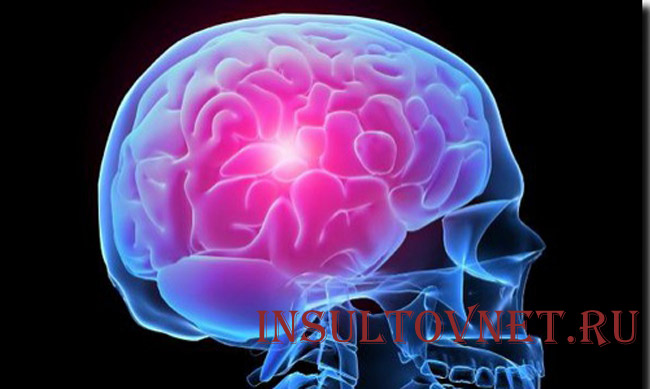 Кровоизлияние в мозг