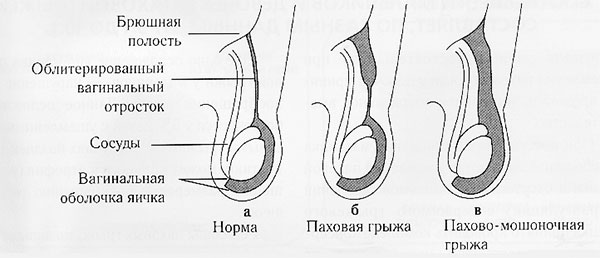 Причины образования и лечение паховых грыж у детей