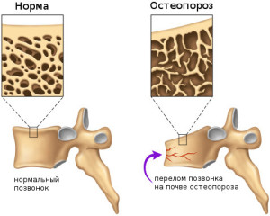 Позвонки При остеопорозе возрастает риск получения компрессионного перелома