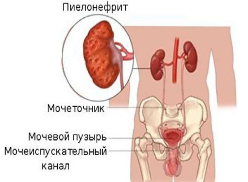 Пиелонефрит