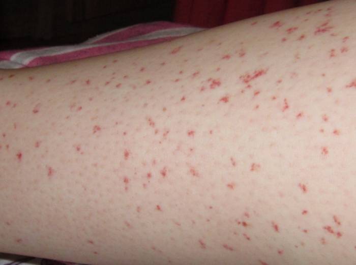 сыпь на коже
