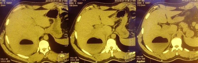 амебный абсцесс печени