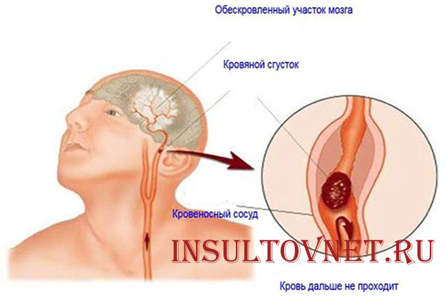 Причина инсульта мозжечка