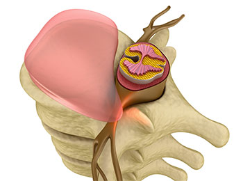 Лечение протрузии поясничного отдела позвоночника с помощью упражнений