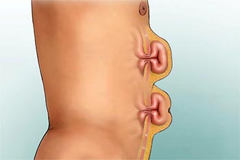 Все о вентральных грыжах. Из за чего они появляются и как с ними бороться