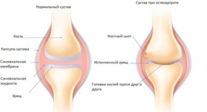 Причины боли в суставах