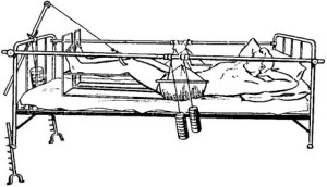 Больной на кровати Фиксация тела на ортопедической кровати