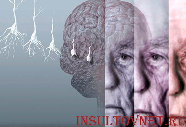 дистрофия мозга