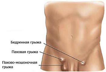 Как определить и чем лечить паховую грыжу мужчинам