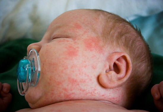 стрептодермия у грудничка