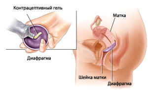 Использование гормонального геля
