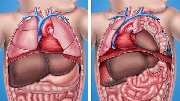 рисунок диафрагмальной грыжи у ребенка