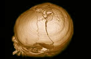 трещина в черепе При переломе происходит повреждение мозга, а также его оболочек