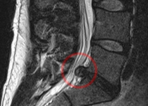 МРТ снимок при межпозвоночной грыже Межпозвоночная грыжа