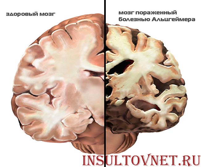мозг при альцгеймере