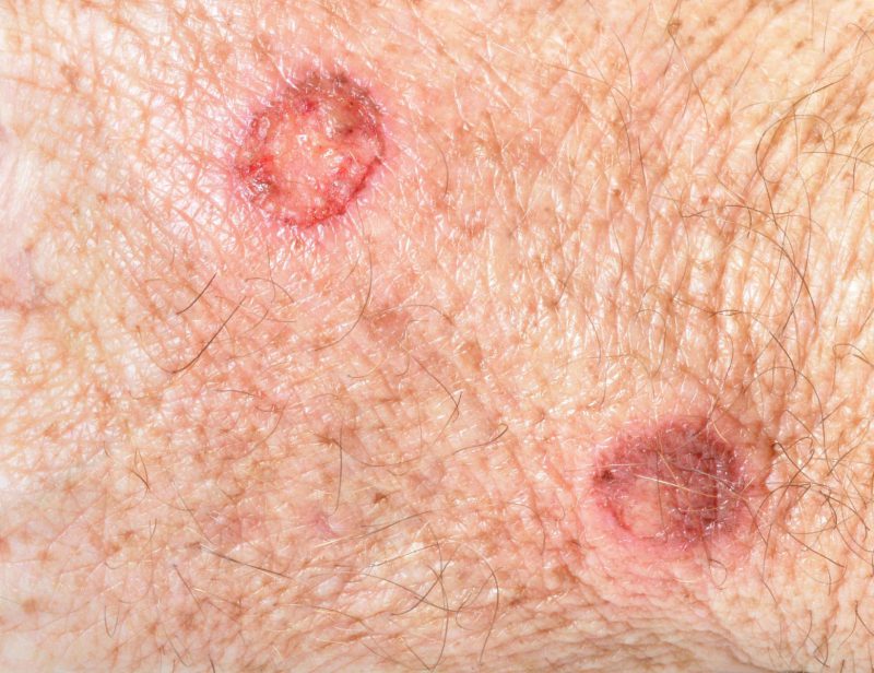 Чесотка с пиодермией