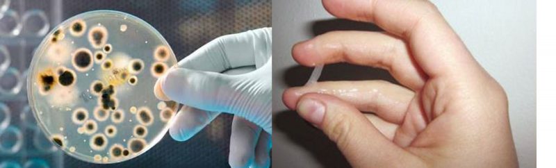 Трихомониаз