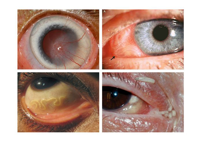 Ленточные черви