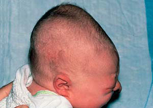 Кефалогематома Кефалогематома является следствие родовой травмы