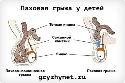Причины образования и лечение паховых грыж у детей