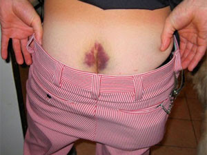 Синяк на пояснице В месте повреждения образуется припухлость