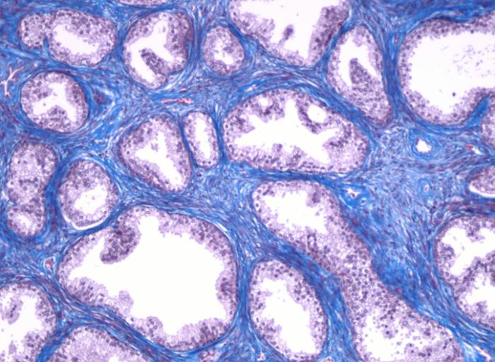 Эхинококкоз