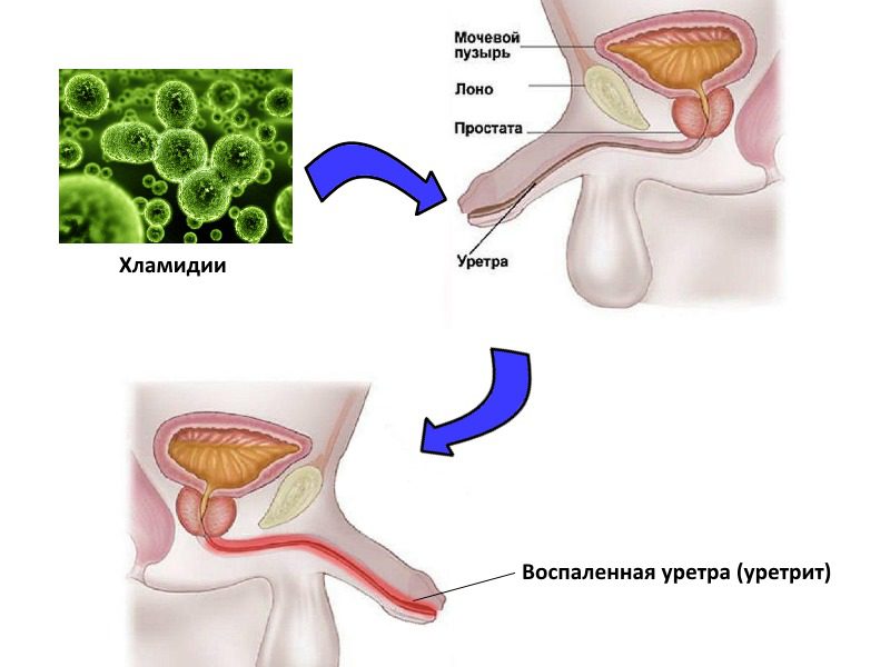 проявления уретрита у мужчин