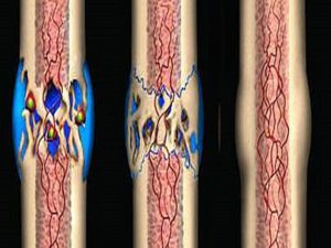 Сросшийся перелом с формированием костной мозоли Сращивание перелома