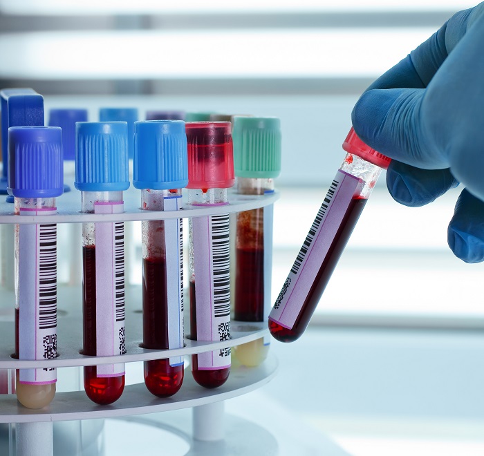 Анализ крови - метод диагностики описторхоза