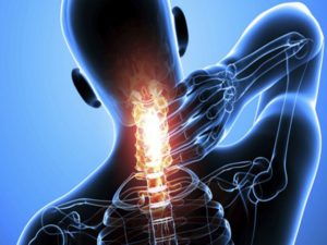 Вывих шейного позвонка Вывих шеи