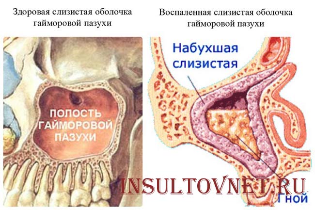 Воспаление гайморовых пазух