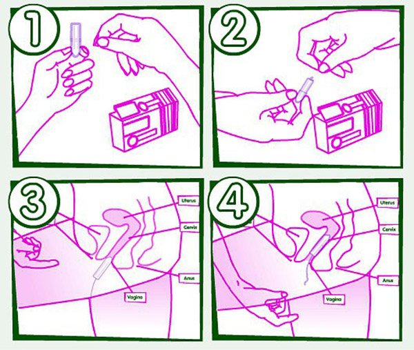 как вводить вагинальные свечи